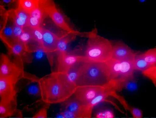 This undated fluorescence-colored microscope image made available by the National Institutes of Health in September 2016 shows a culture of human breast cancer cells. A study discussed at the 2022 meeting of the American Society of Clinical Oncology suggests some low-risk breast cancer patients can omit radiation after lumpectomy. (Ewa Krawczyk/National Cancer Institute via AP)